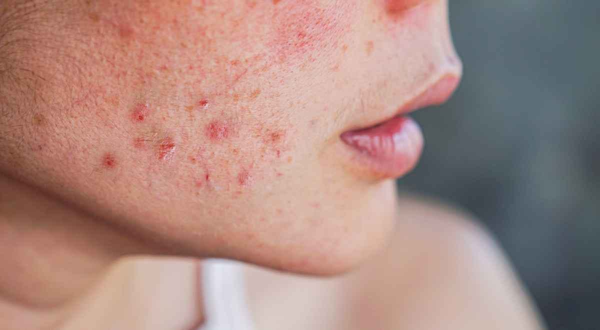 irritated skin with red marks
