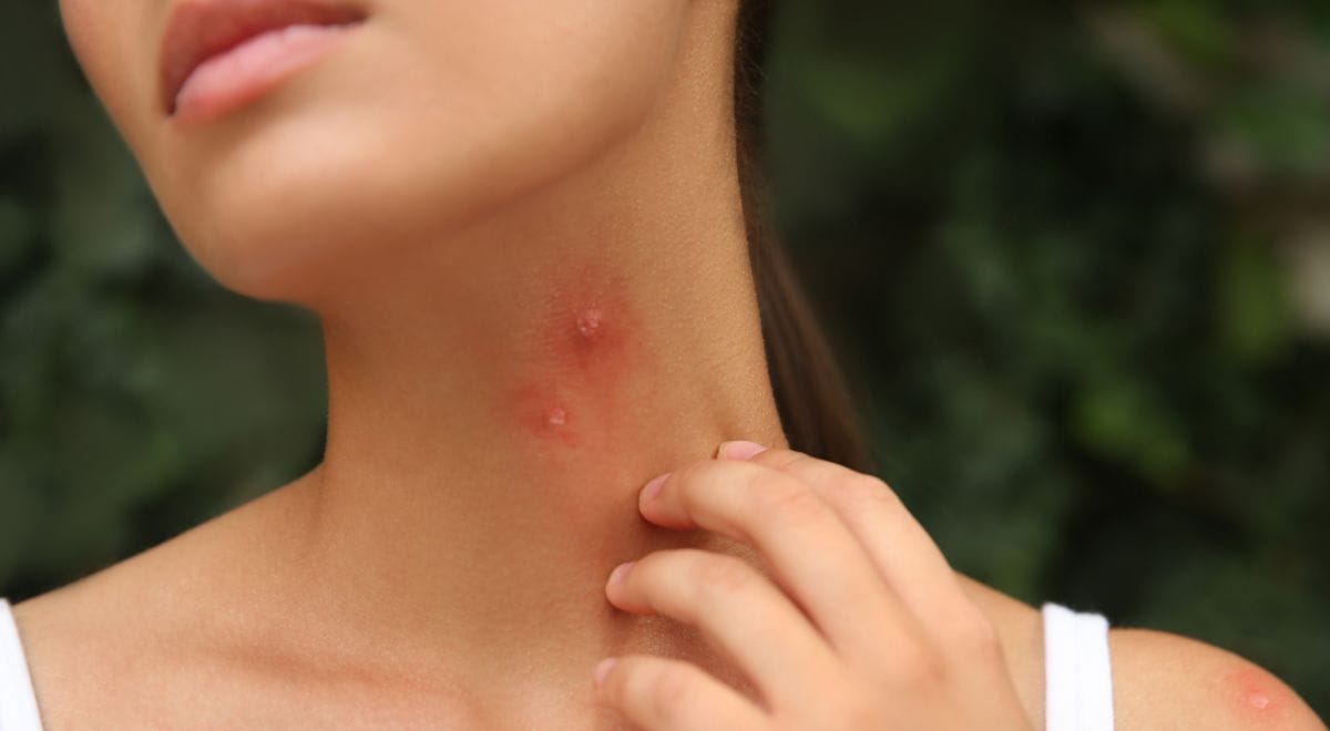 5 Simple Home Remedies for Mosquito Bites: Soothing the Itch