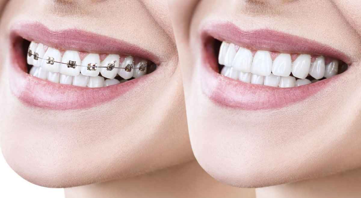 Traditional Braces vs Clear Aligners