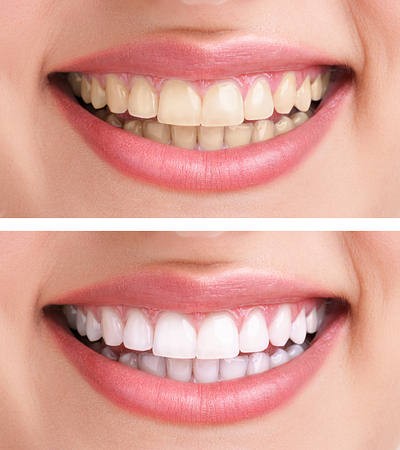 teeth before and after