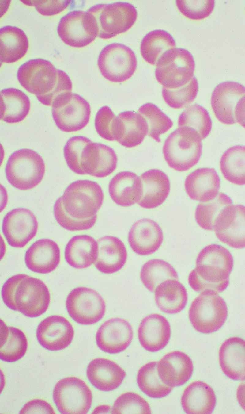 Thalassemia: Know Your Red Blood Cells img